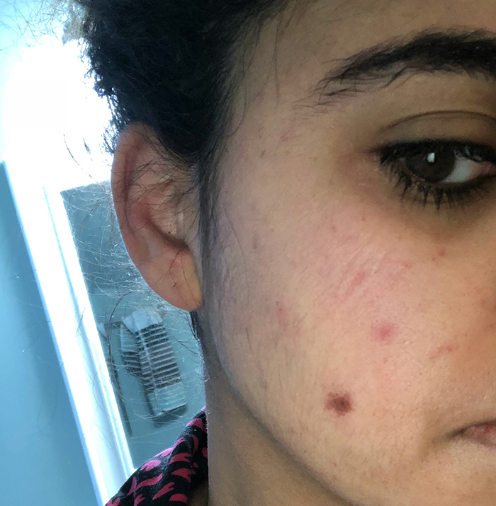 vitamin C scar before and after